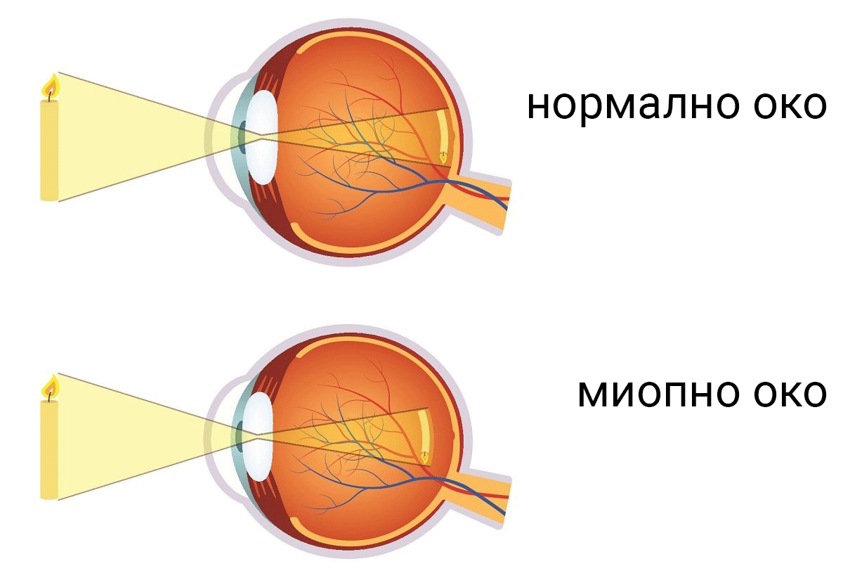 Miopija 02